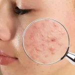 How to Get Rid of Pimples, a Powerful Solution for Smooth, Problem-Free Skin