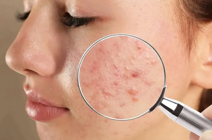 How to Get Rid of Pimples, a Powerful Solution for Smooth, Problem-Free Skin